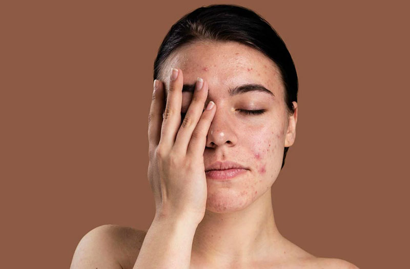 Cách Chăm Sóc Da Nhạy Cảm Dễ Bị Kích Ứng