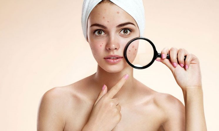 Có Nên Dùng Kem Dưỡng Khi Bị Mụn Hay Không?