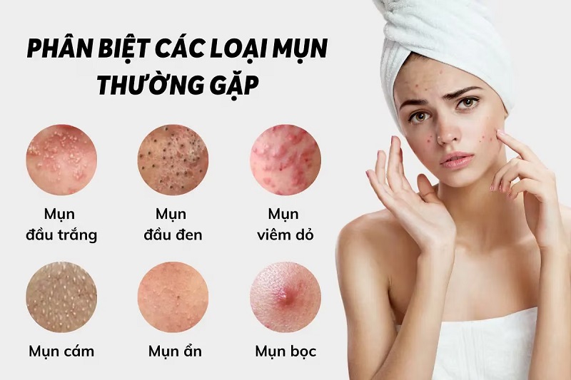 Phân Biệt Các Loại Mụn Và Cách Điều Trị Hiệu Quả