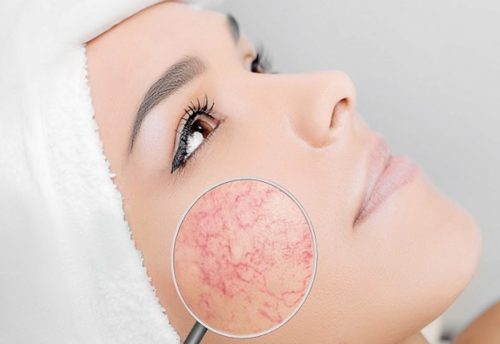 Da Bị Giãn Mao Mạch Có Nguy Hiểm Không