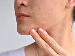 Top 10 Sản Phẩm Phục Hồi Da Nhiễm Corticoid Đang Hot Nhất Hiện Nay