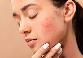 Tác Hại của Kem Dưỡng Ẩm Kém Chất Lượng