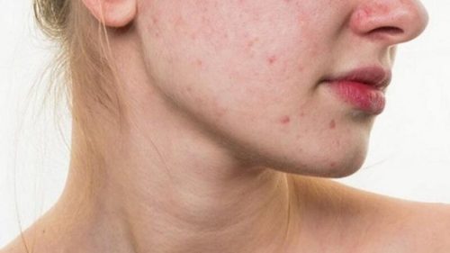 Làm Gì Khi Da Bị Kích Ứng Đỏ Rát