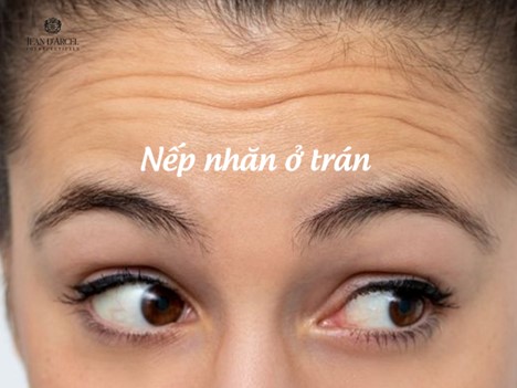 Nguyên Nhân Xuất Hiện Nếp Nhăn Ở Trán