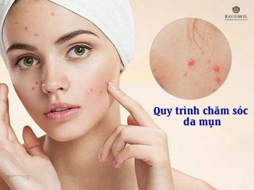 QUY TRÌNH CHĂM SÓC DA MỤN VỚI SẢN PHẨM JEAN D ARCEL