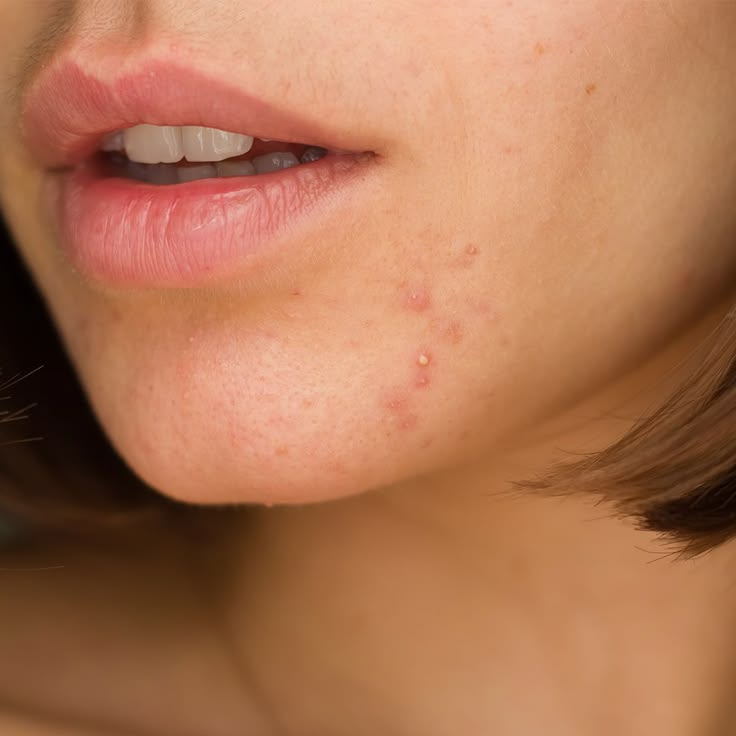 Chăm sóc da mụn đúng cách để duy trì làn da khỏe đẹp