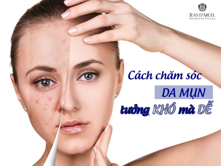 CÁCH CHĂM SÓC DA MỤN TƯỞNG KHÓ MÀ DỄ