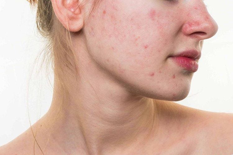 Da Bị Kích Ứng Nên Bôi Gì?