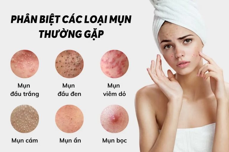 Phân Biệt Các Loại Mụn Và Cách Điều Trị Hiệu Quả