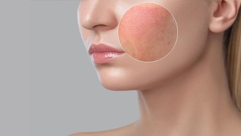 Da Nhạy Cảm Dễ Kích Ứng Nên Dùng Gì?