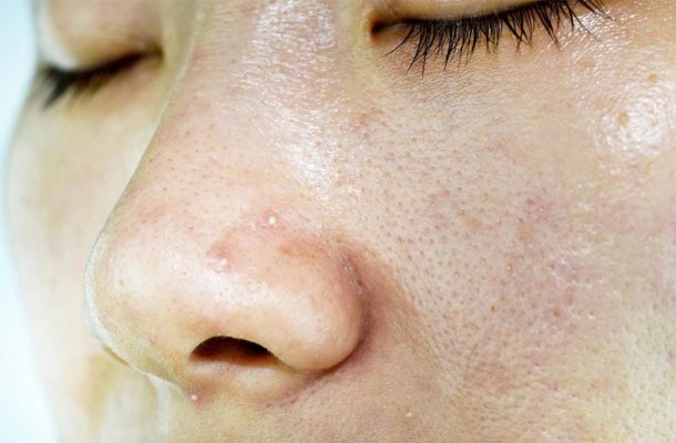 Tại Sao Da Dầu Mụn Thường Khó Hấp Thụ Dưỡng Chất