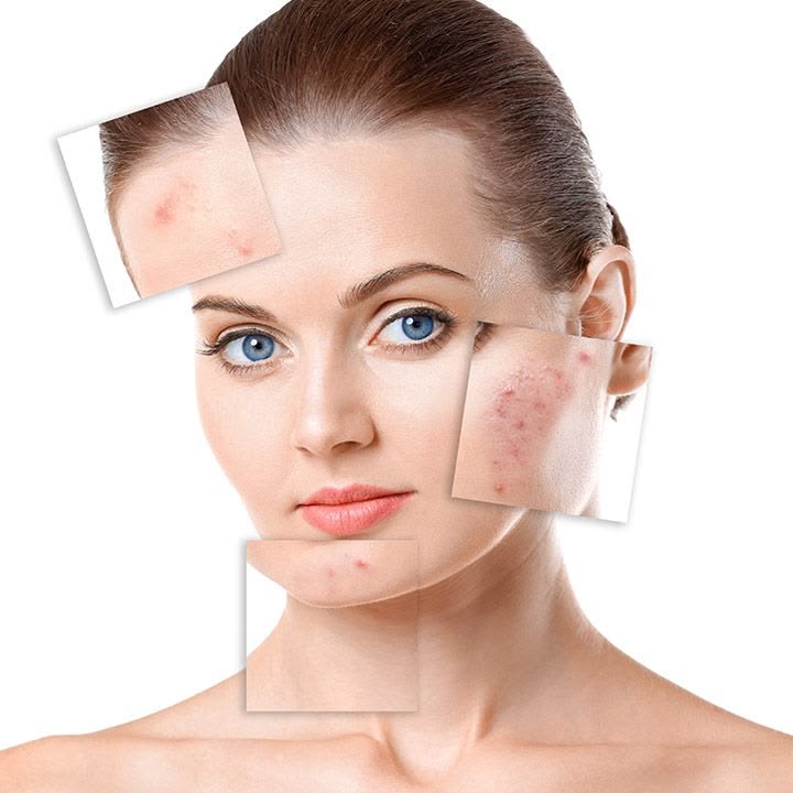 Mụn Nội Tiết: Nguyên Nhân, Triệu Chứng Và Phương Pháp Xử Lý Tối Ưu